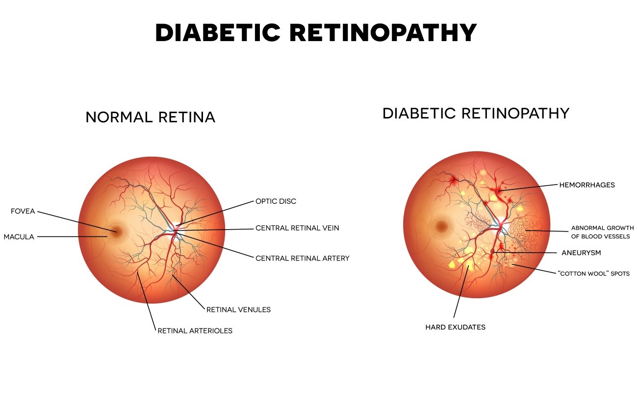 retinoplastia-diabetica-02