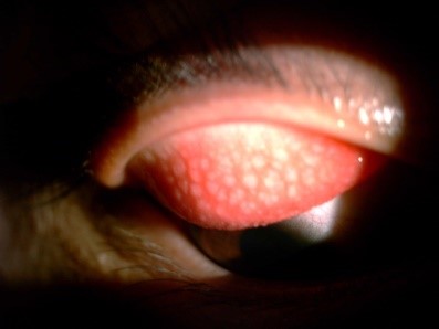 alergia-ocular-2