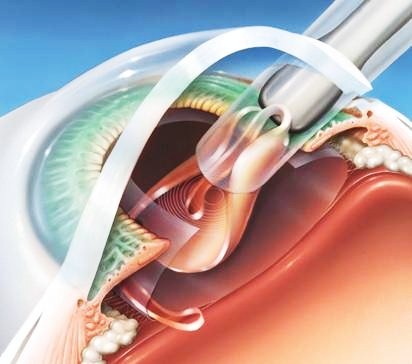 implante-da-lente-intra-ocular